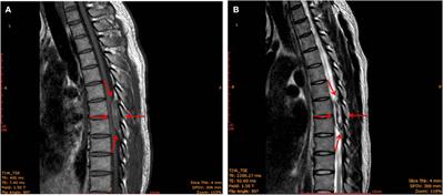 Case report: Paralysis after epidural analgesia due to a hemorrhage of pure epidural venous hemangioma